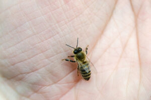 Bee stinger stuck under skin